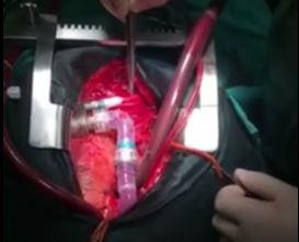 В Украине впервые пересадили механическoе сердце